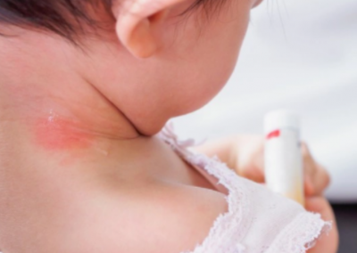 Dermatitis atópica: manejo interdisciplinario y cuándo remitir al dermatólogo y/o alergólogo